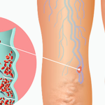 Treating Varicose Veins
