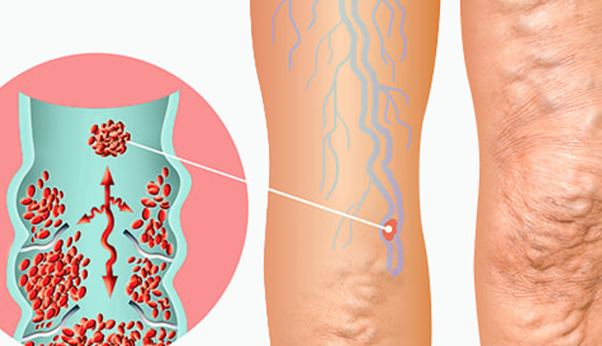 Treating Varicose Veins