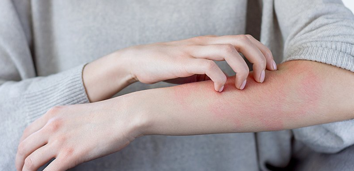 Food Allergy