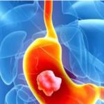 Лечение гастрита