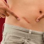 Appendicitis Symptoms: What You Need to Know