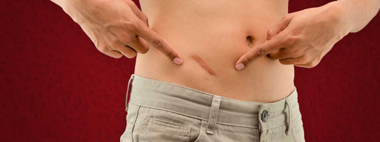Appendicitis Symptoms: What You Need to Know
